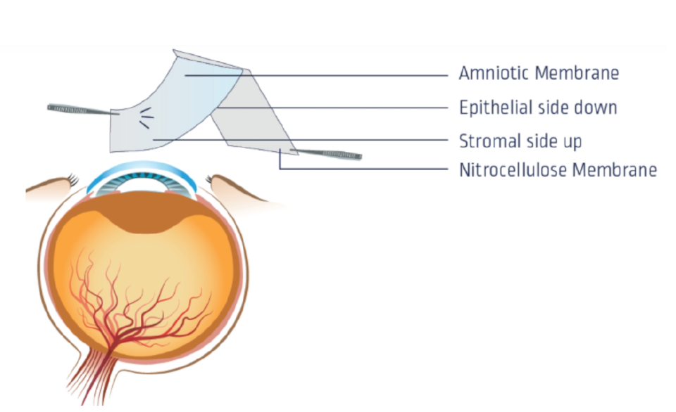 Cryopreserved AmnioMatrix