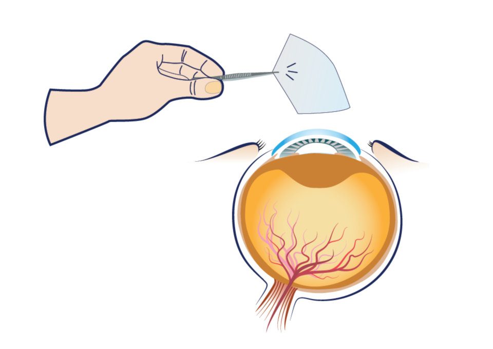 What Is AmnioMatrix?